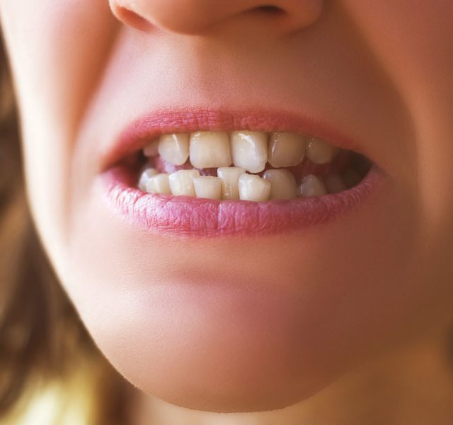 Treatment For Crowded Teeth