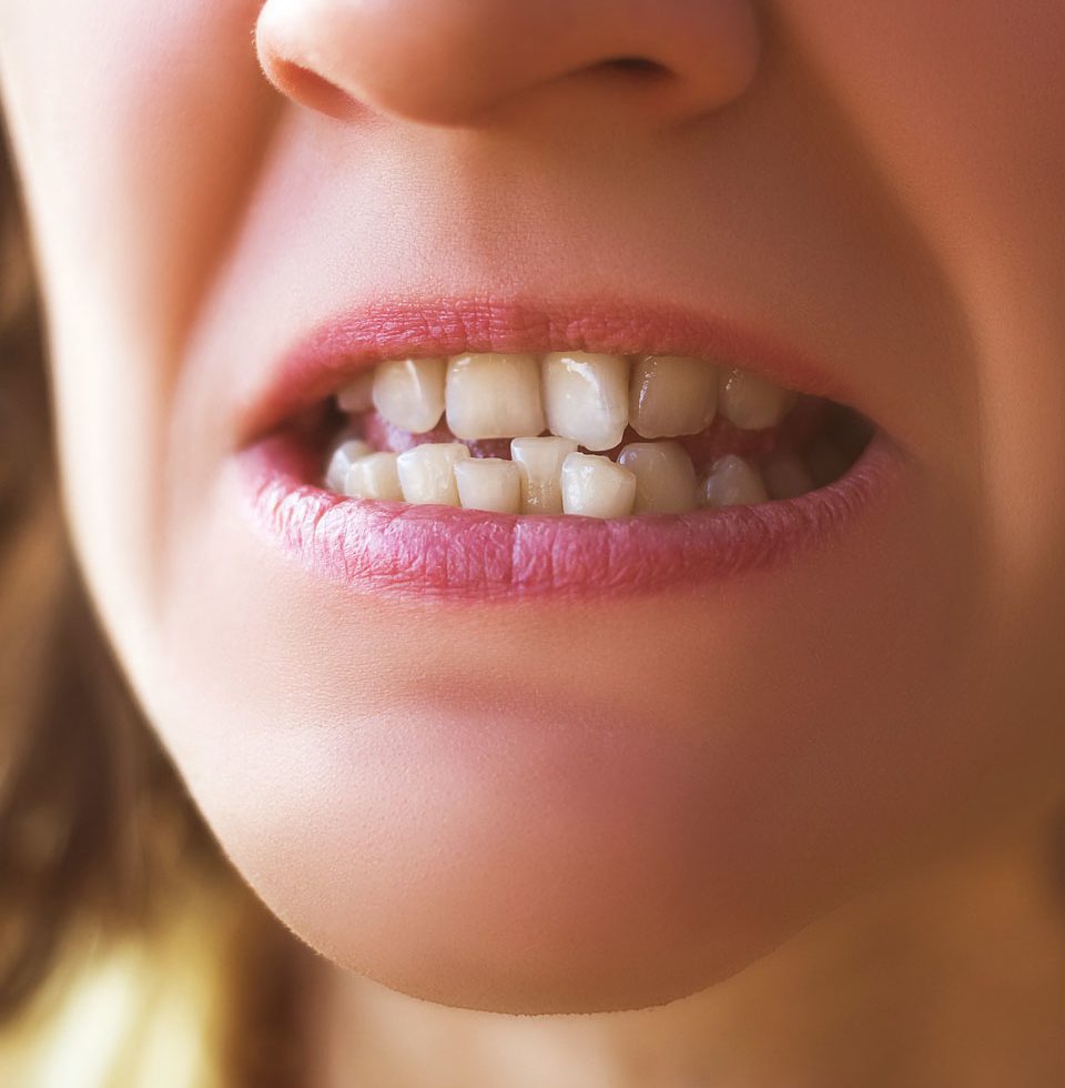 Treatment For Crowded Teeth