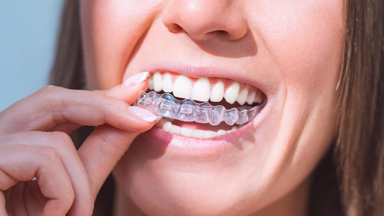 invisalign
